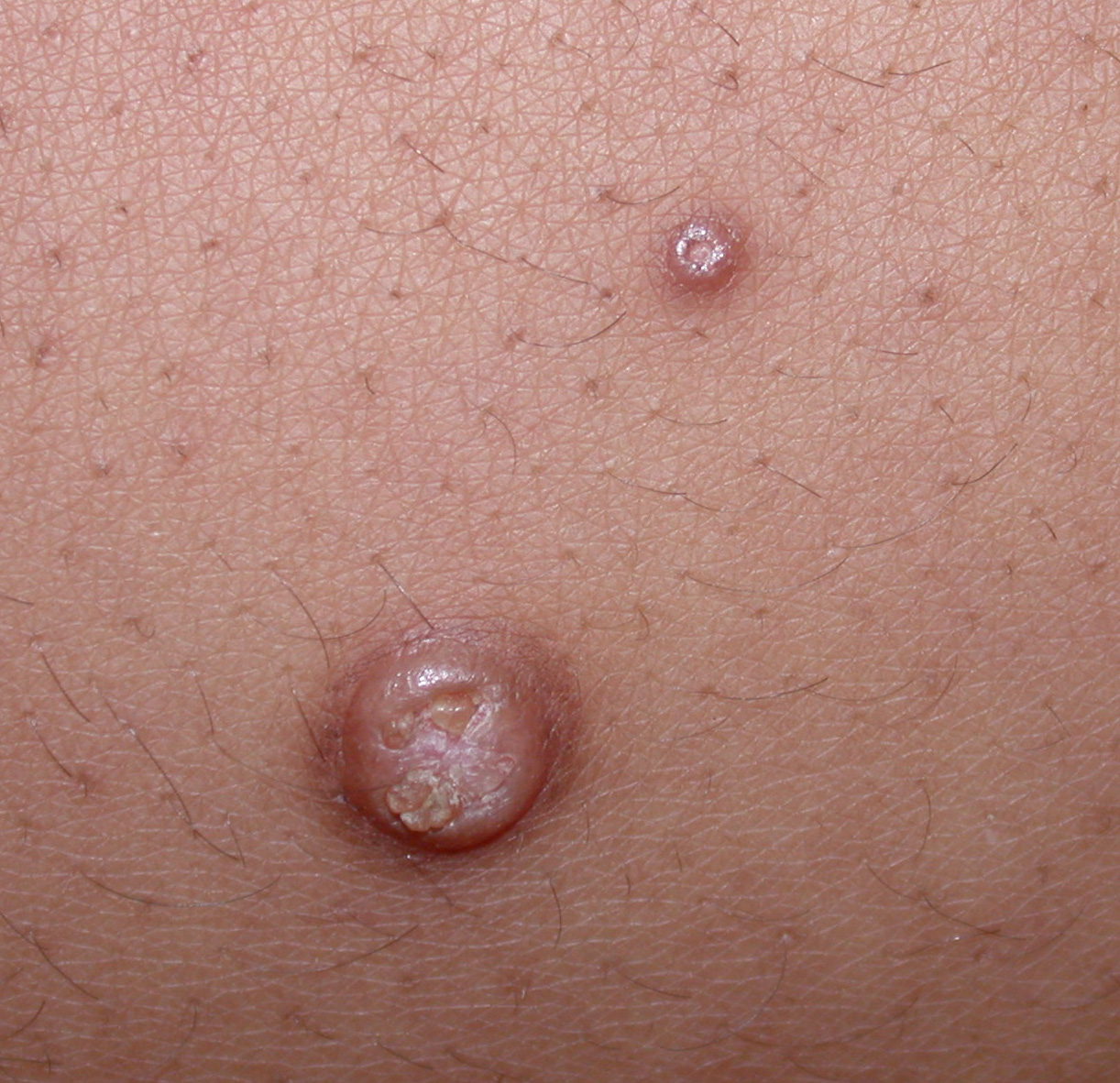 Molluscum Contagiosum or Genital Warts? (Photos and pictures)